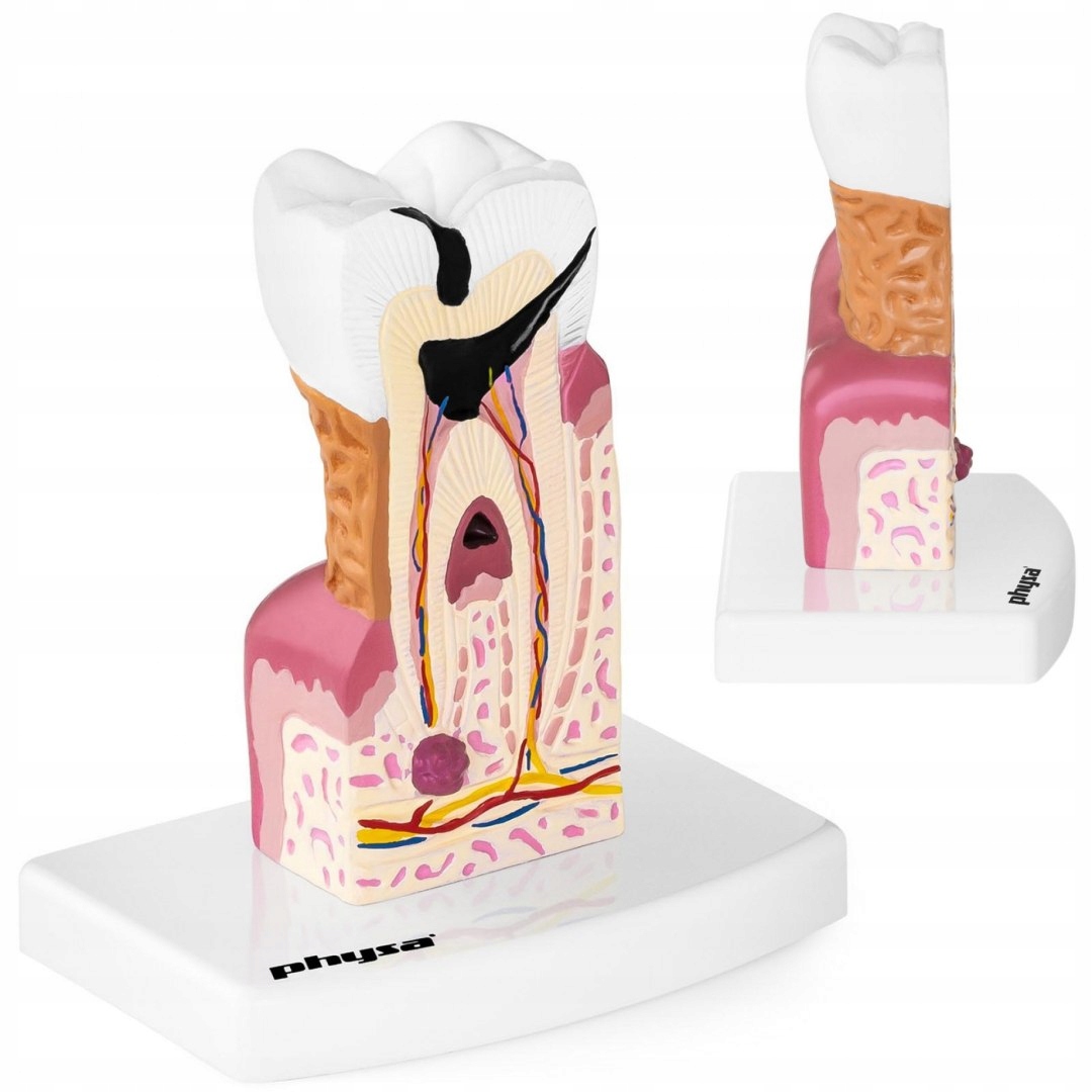 Anatomický model chorého ľudského zuba na škále 6